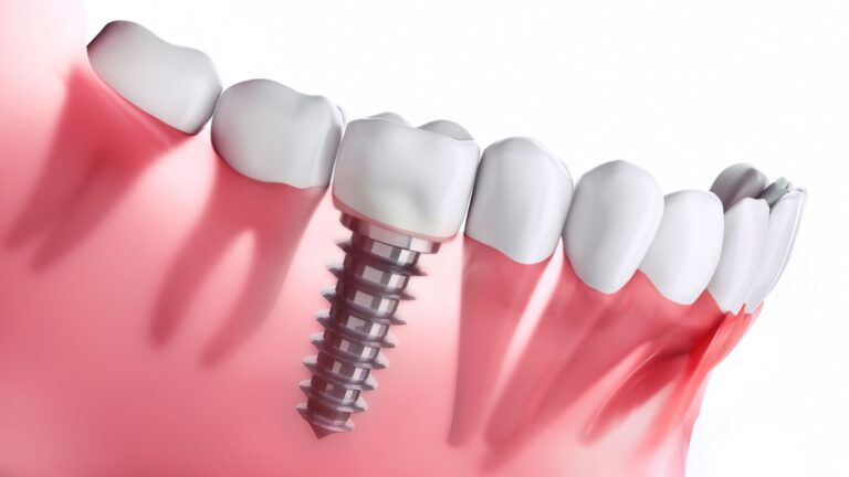 Understanding the Lifespan of Dental Implants