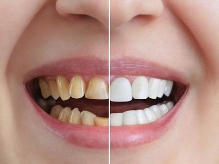 Professional Teeth Whitening